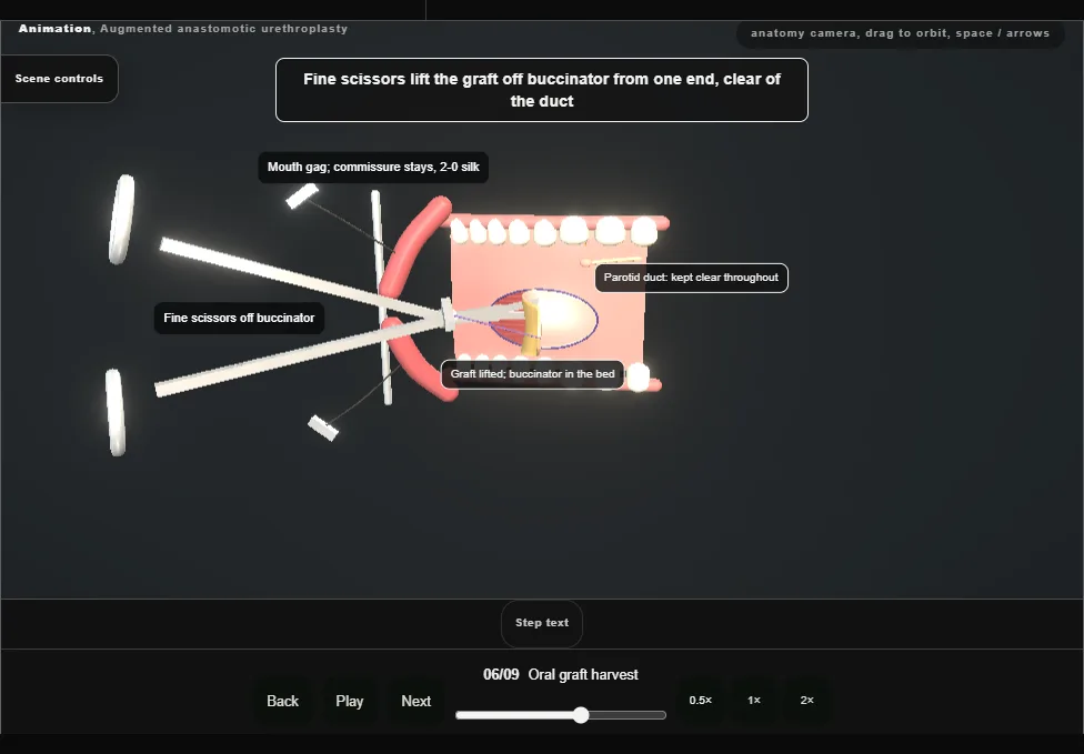 Augmented anastomotic urethroplasty. Step 6: Oral graft harvest. Captured frame from the interactive animation.