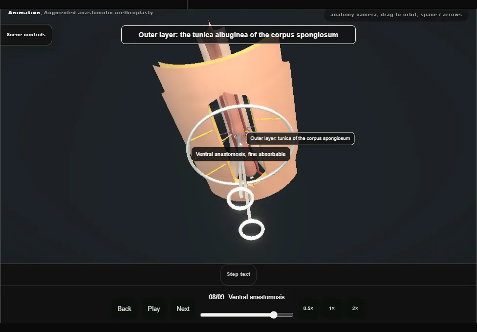 Augmented anastomotic urethroplasty. Step 8: Ventral anastomosis. Captured frame from the interactive animation.