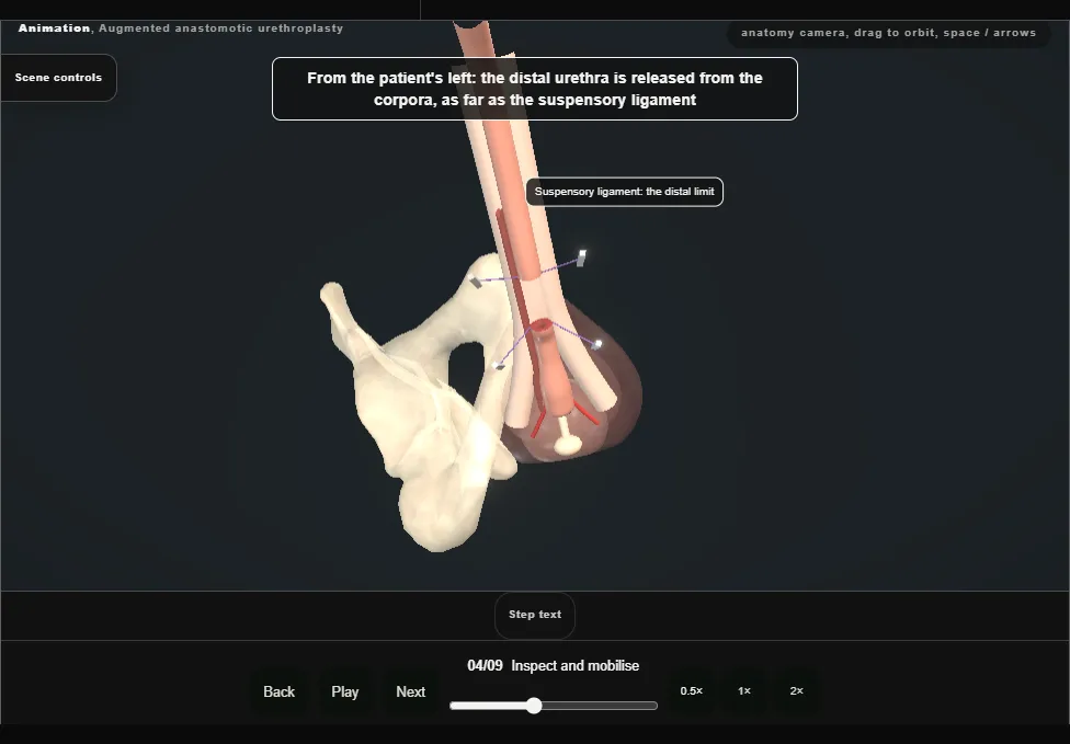 Augmented anastomotic urethroplasty. Step 4: Inspect and mobilise. Captured frame from the interactive animation.