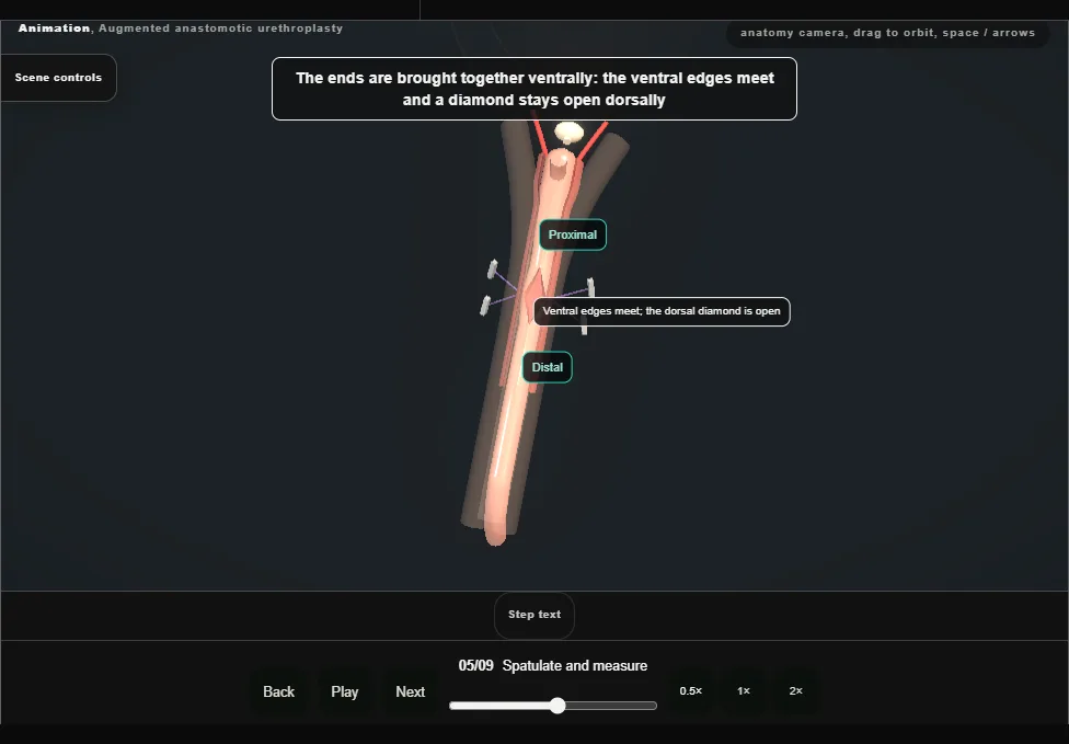 Augmented anastomotic urethroplasty. Step 5: Spatulate and measure. Captured frame from the interactive animation.