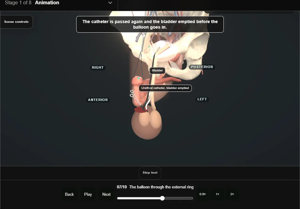 Artificial urinary sphincter: penoscrotal. Step 7: The balloon through the external ring. Captured frame from the interactive animation.