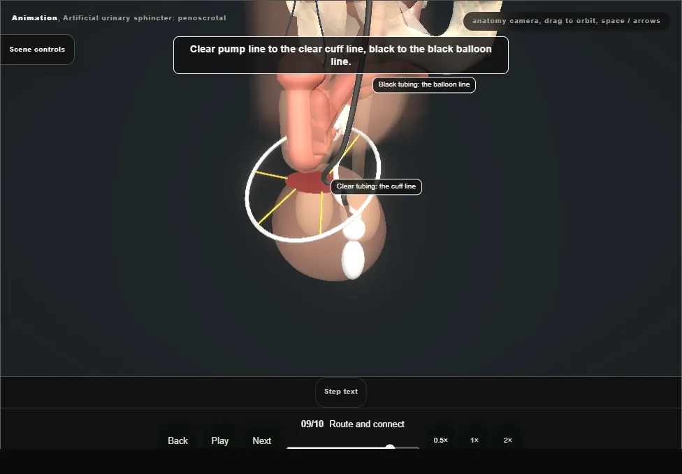 Artificial urinary sphincter: penoscrotal. Step 9: Route and connect. Captured frame from the interactive animation.