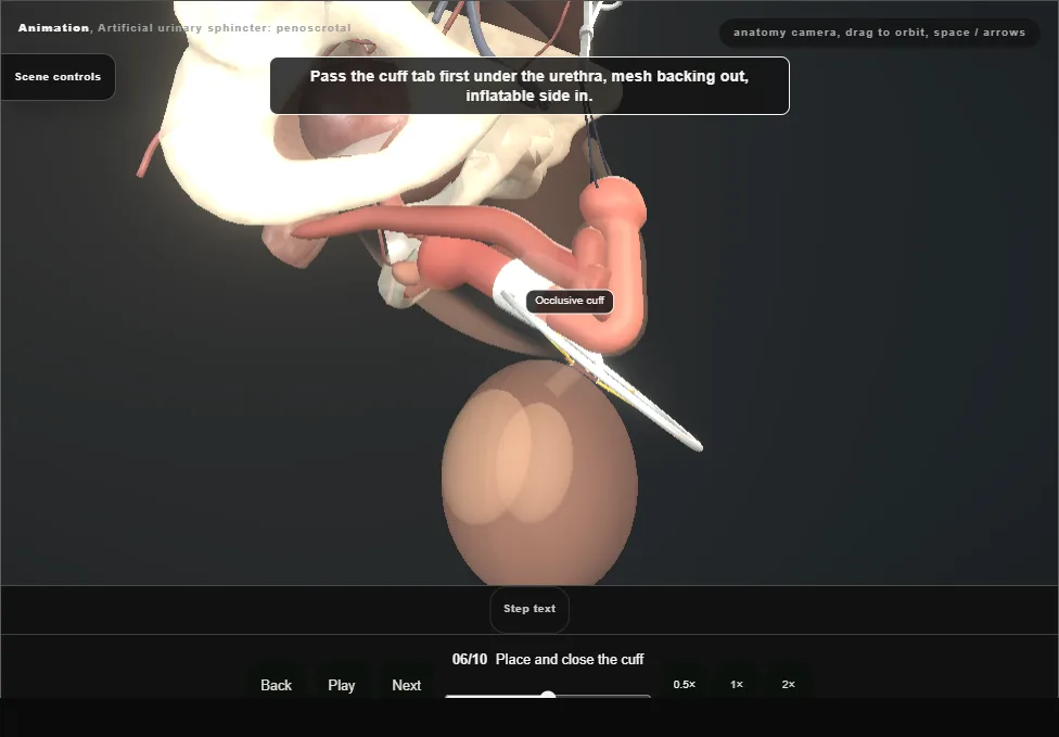 Artificial urinary sphincter: penoscrotal. Step 6: Place and close the cuff. Captured frame from the interactive animation.