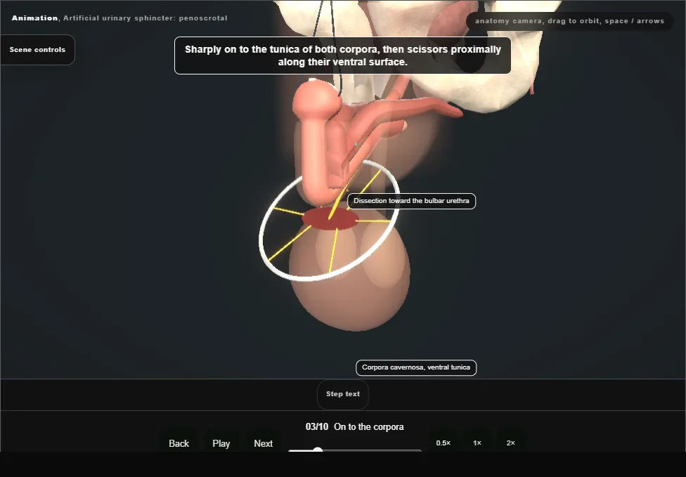 Artificial urinary sphincter: penoscrotal. Step 3: On to the corpora. Captured frame from the interactive animation.