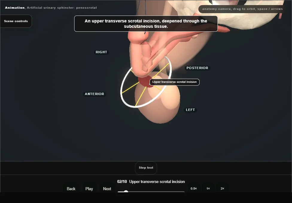 Artificial urinary sphincter: penoscrotal. Step 2: Upper transverse scrotal incision. Captured frame from the interactive animation.