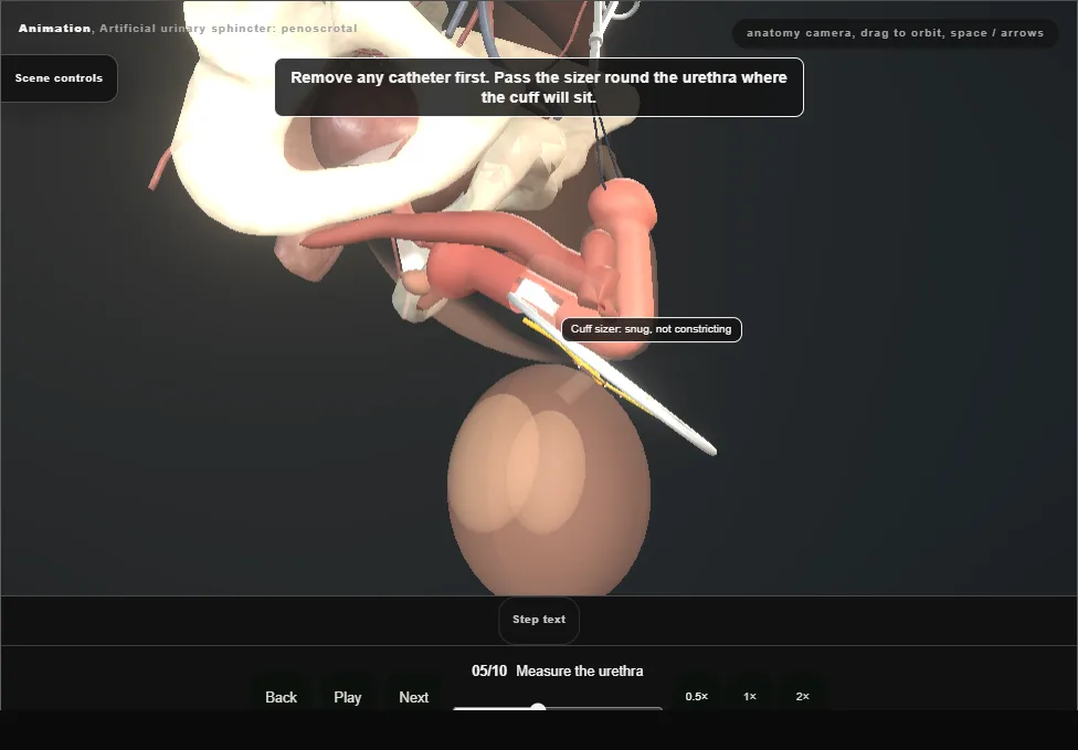 Artificial urinary sphincter: penoscrotal. Step 5: Measure the urethra. Captured frame from the interactive animation.