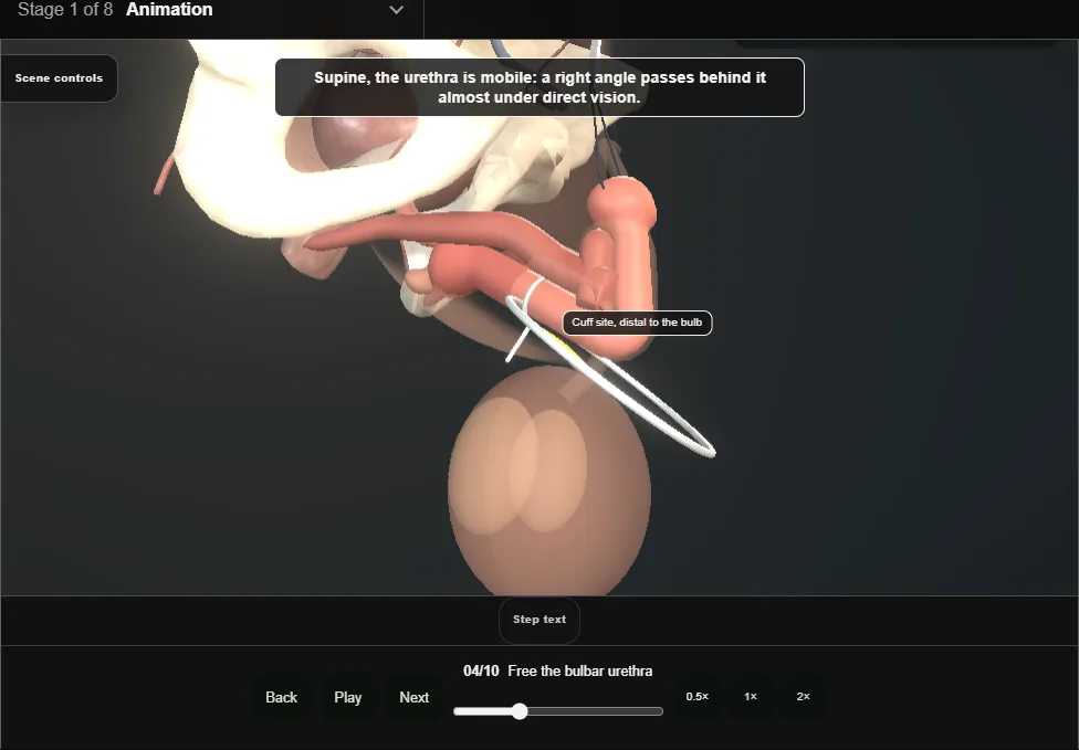 Artificial urinary sphincter: penoscrotal. Step 4: Free the bulbar urethra. Captured frame from the interactive animation.