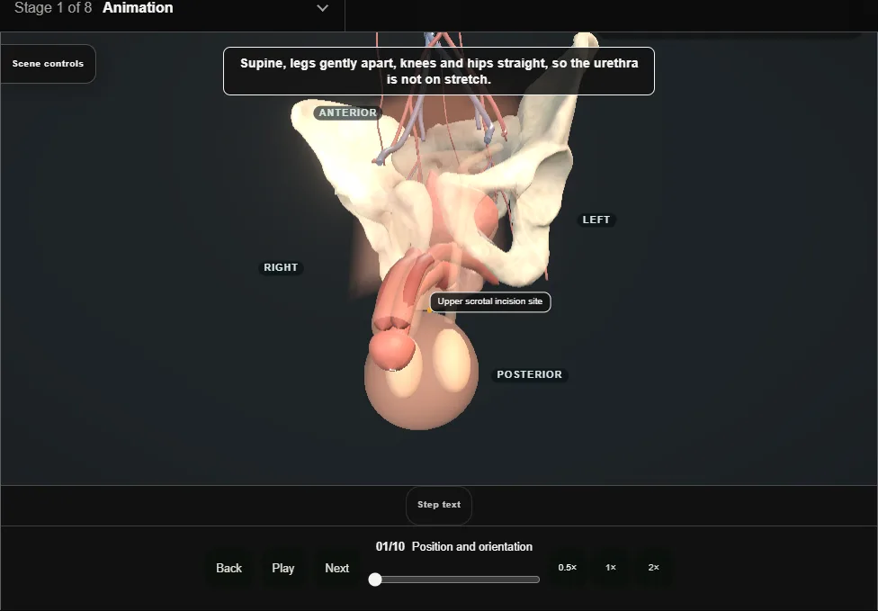 Artificial urinary sphincter: penoscrotal. Step 1: Position and orientation. Captured frame from the interactive animation.