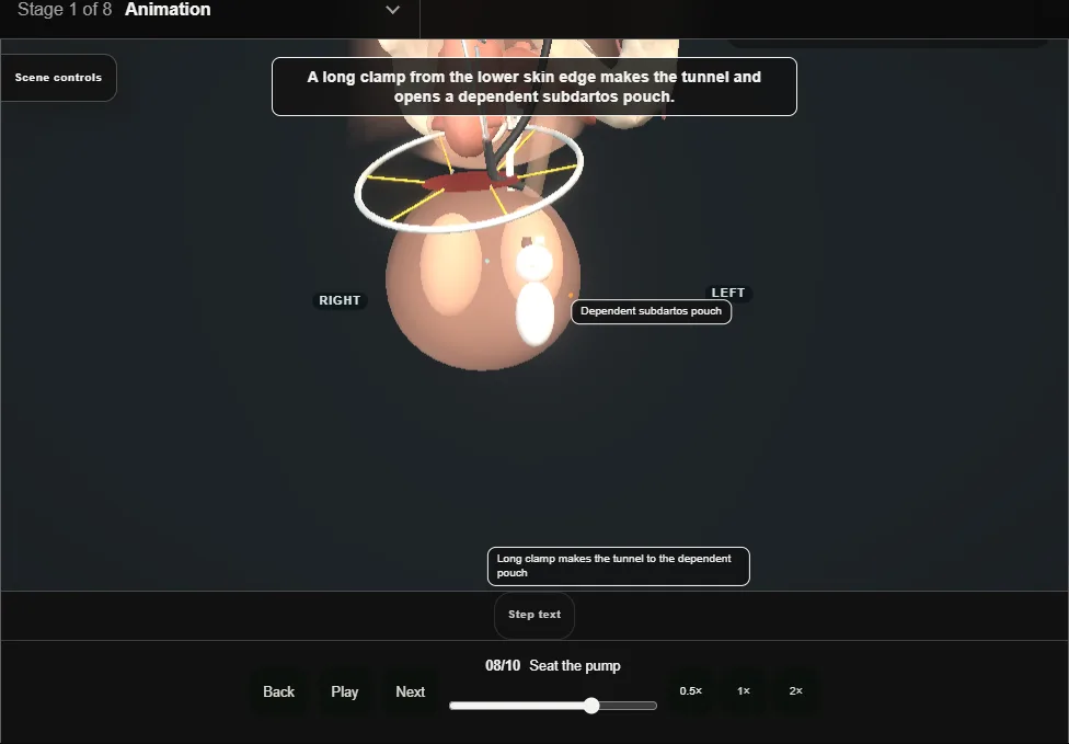 Artificial urinary sphincter: penoscrotal. Step 8: Seat the pump. Captured frame from the interactive animation.