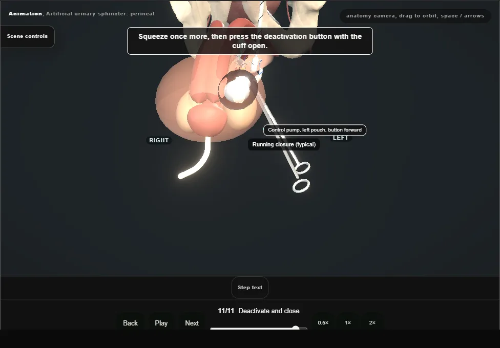 Artificial urinary sphincter: perineal. Step 11: Deactivate and close. Captured frame from the interactive animation.