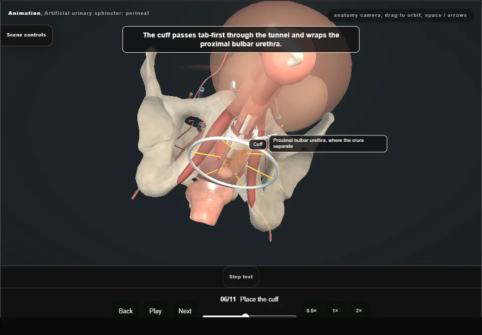 Artificial urinary sphincter: perineal. Step 6: Place the cuff. Captured frame from the interactive animation.