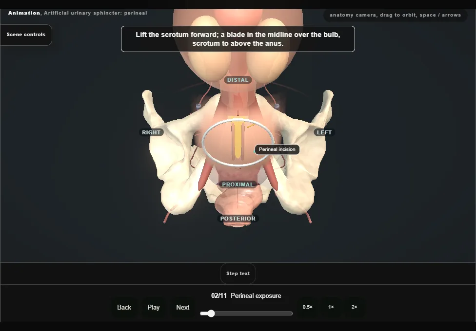 Artificial urinary sphincter: perineal. Step 2: Perineal exposure. Captured frame from the interactive animation.