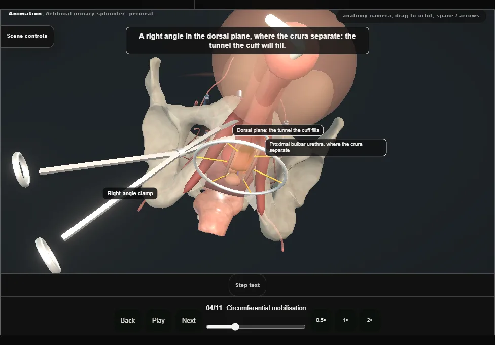 Artificial urinary sphincter: perineal. Step 4: Circumferential mobilisation. Captured frame from the interactive animation.