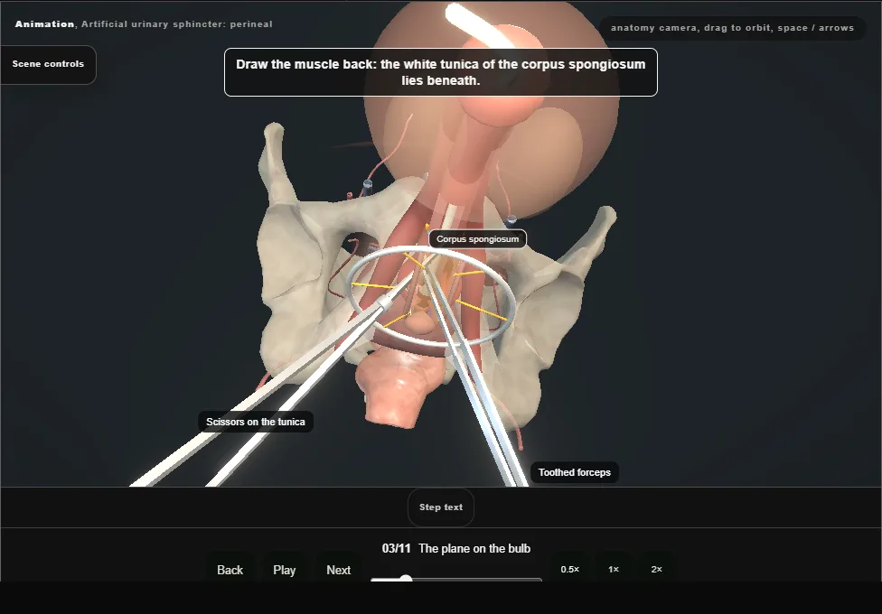 Artificial urinary sphincter: perineal. Step 3: The plane on the bulb. Captured frame from the interactive animation.