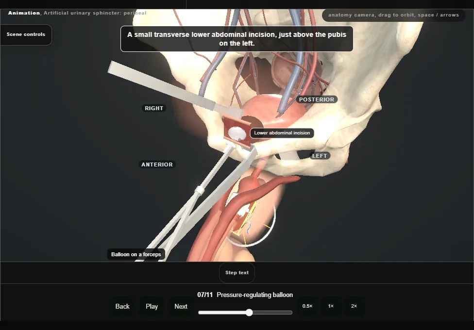Artificial urinary sphincter: perineal. Step 7: Pressure-regulating balloon. Captured frame from the interactive animation.
