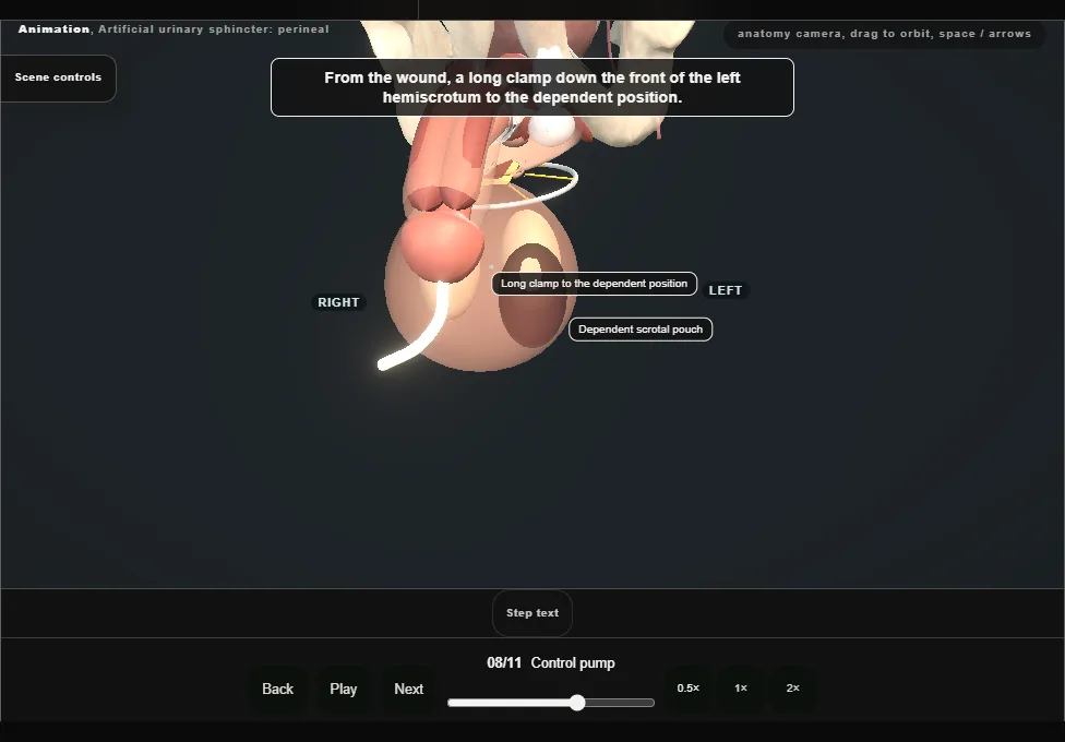 Artificial urinary sphincter: perineal. Step 8: Control pump. Captured frame from the interactive animation.