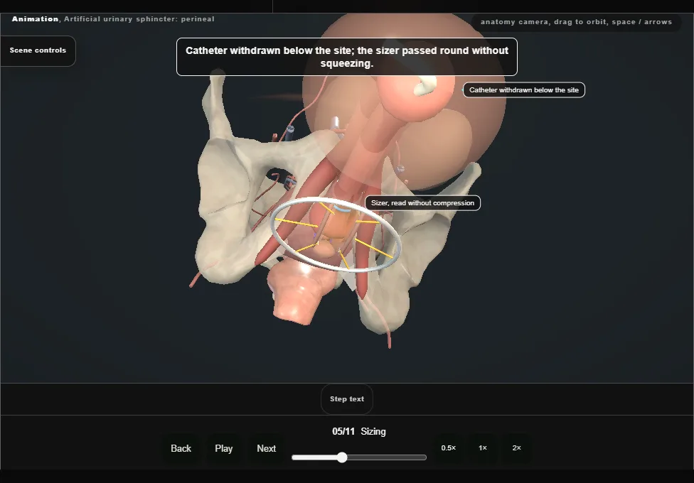 Artificial urinary sphincter: perineal. Step 5: Sizing. Captured frame from the interactive animation.