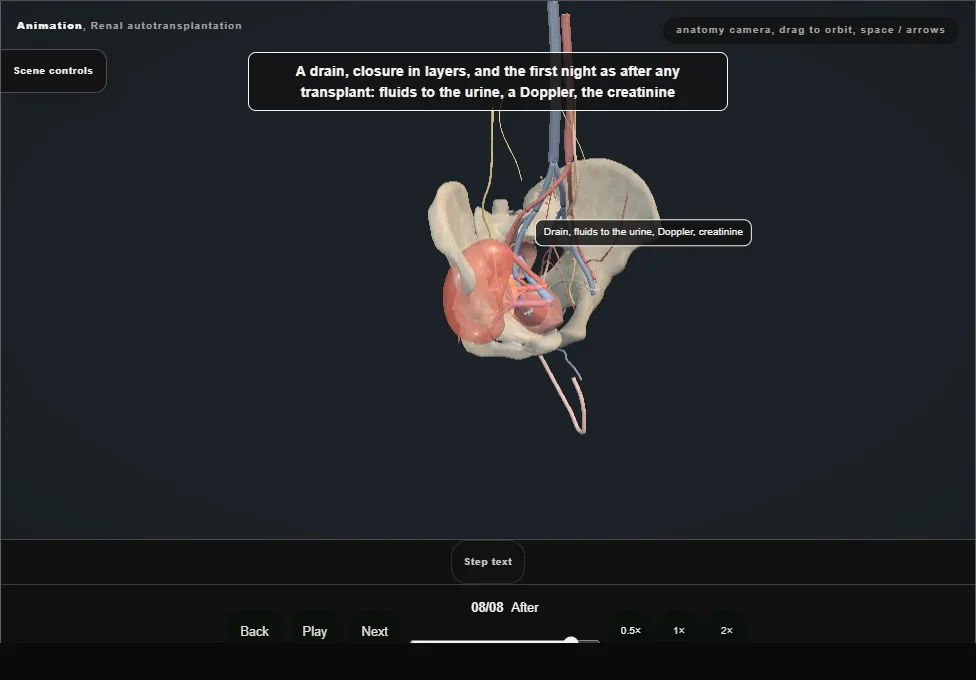 Renal autotransplantation. Step 8: After. Captured frame from the interactive animation.