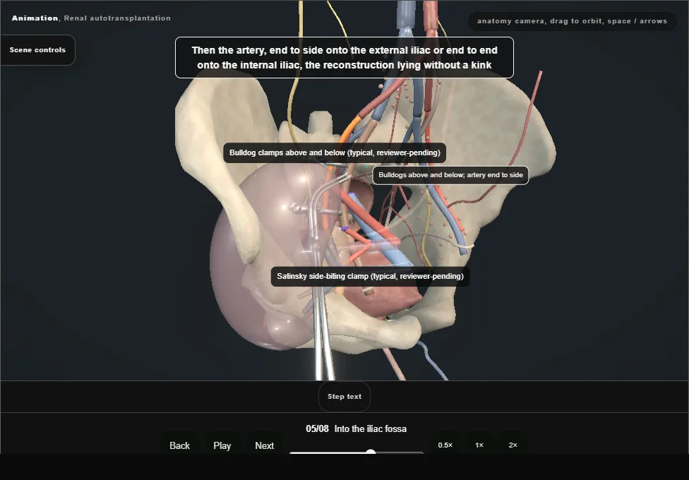 Renal autotransplantation. Step 5: Into the iliac fossa. Captured frame from the interactive animation.