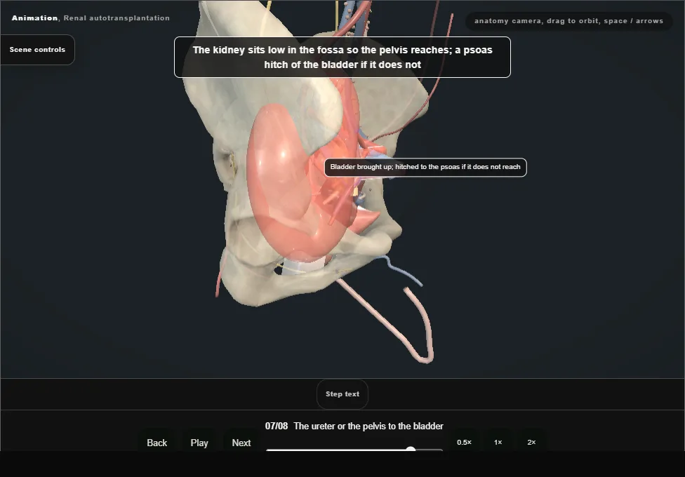 Renal autotransplantation. Step 7: The ureter or the pelvis to the bladder. Captured frame from the interactive animation.