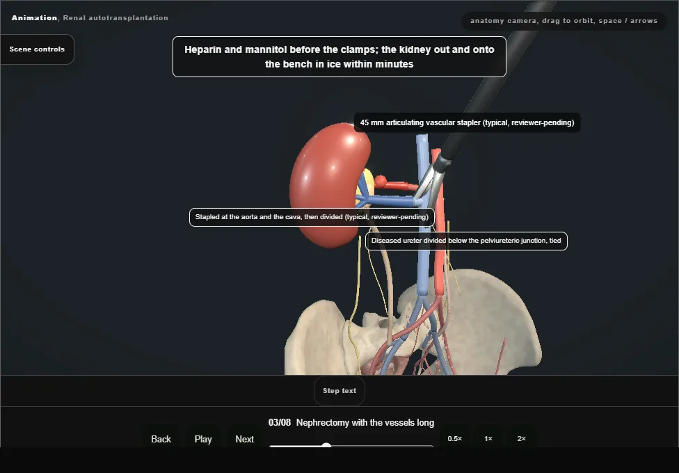 Renal autotransplantation. Step 3: Nephrectomy with the vessels long. Captured frame from the interactive animation.