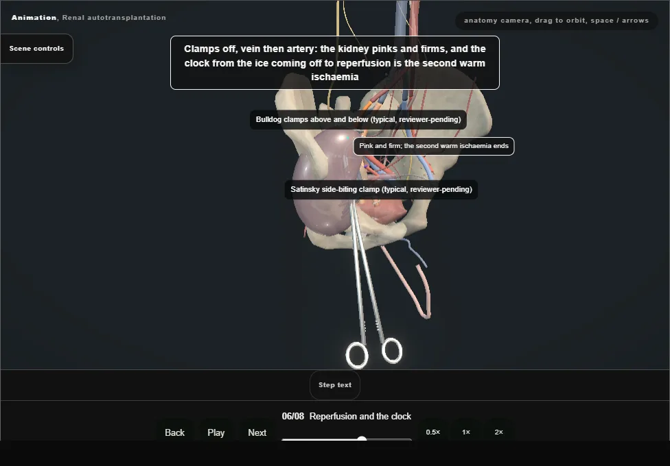 Renal autotransplantation. Step 6: Reperfusion and the clock. Captured frame from the interactive animation.