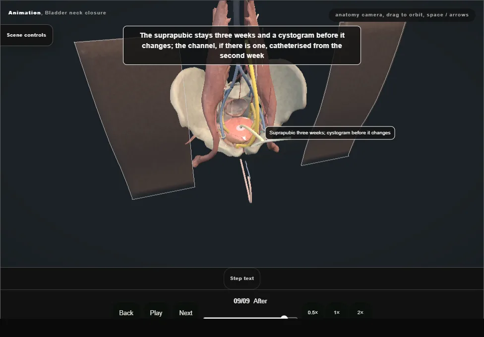 Bladder neck closure. Step 9: After. Captured frame from the interactive animation.