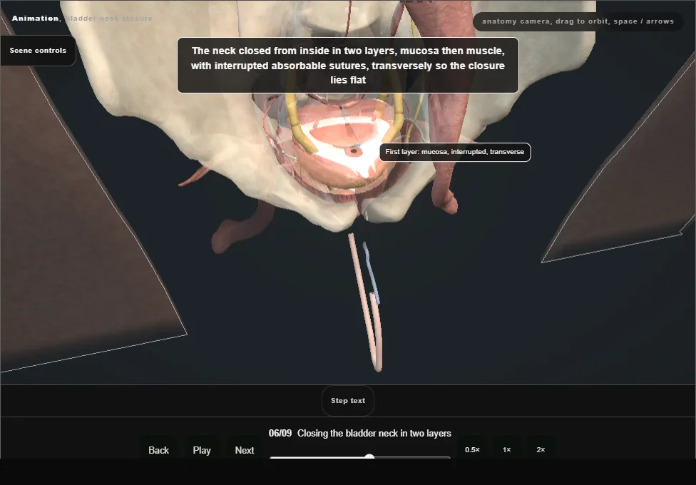 Bladder neck closure. Step 6: Closing the bladder neck in two layers. Captured frame from the interactive animation.