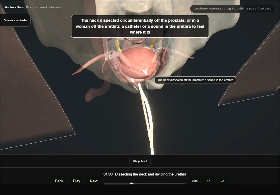 Bladder neck closure. Step 4: Dissecting the neck and dividing the urethra. Captured frame from the interactive animation.