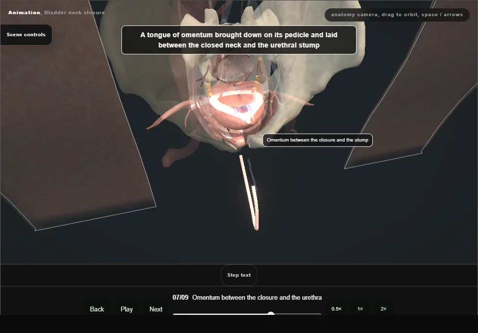 Bladder neck closure. Step 7: Omentum between the closure and the urethra. Captured frame from the interactive animation.