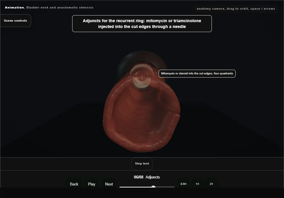 Bladder neck and anastomotic stenosis. Step 6: Adjuncts. Captured frame from the interactive animation.