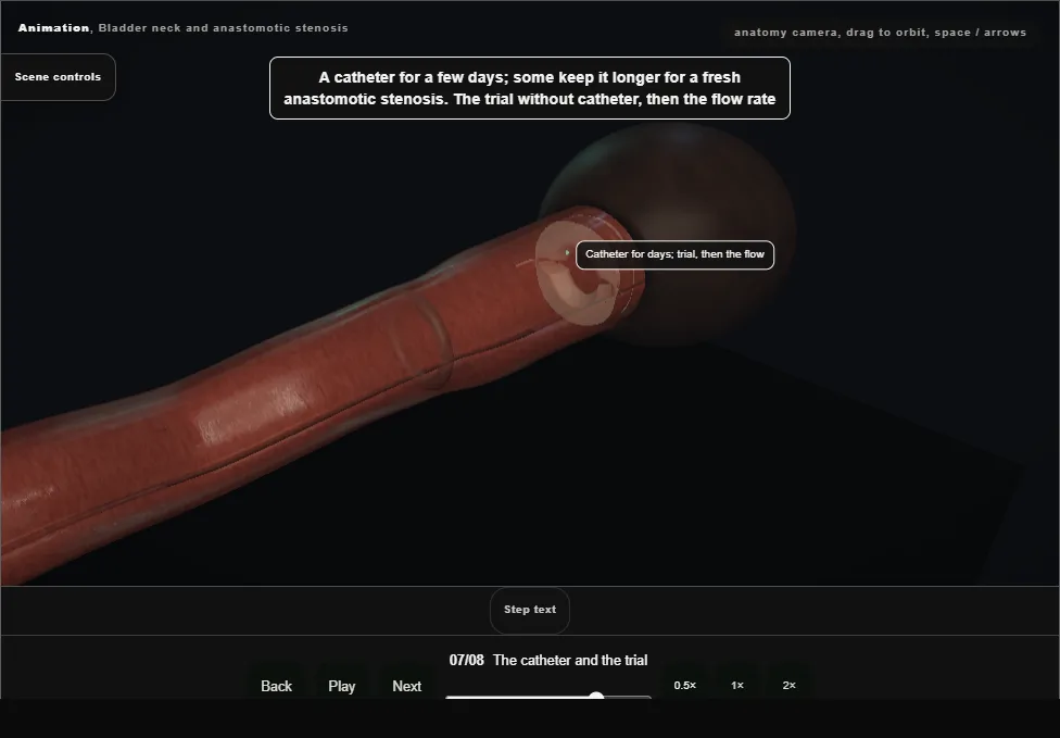 Bladder neck and anastomotic stenosis. Step 7: The catheter and the trial. Captured frame from the interactive animation.