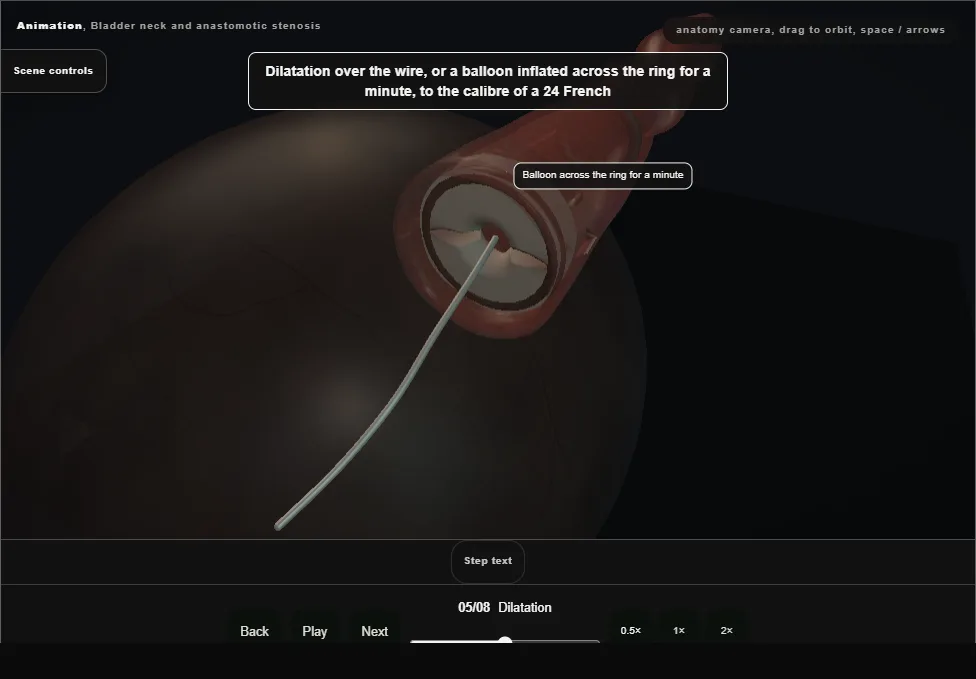 Bladder neck and anastomotic stenosis. Step 5: Dilatation. Captured frame from the interactive animation.