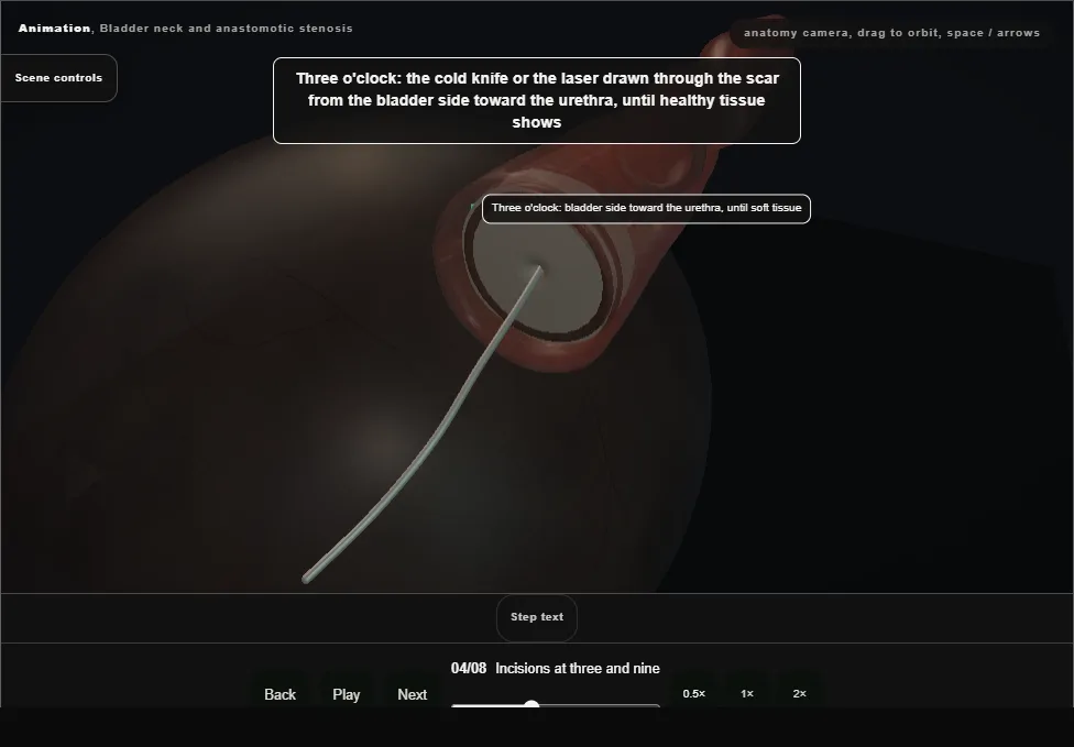 Bladder neck and anastomotic stenosis. Step 4: Incisions at three and nine. Captured frame from the interactive animation.
