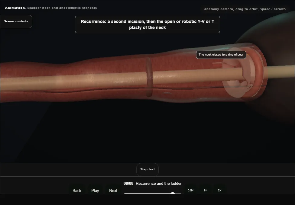 Bladder neck and anastomotic stenosis. Step 8: Recurrence and the ladder. Captured frame from the interactive animation.