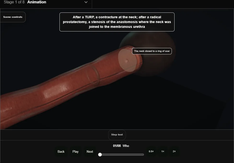 Bladder neck and anastomotic stenosis. Step 1: Who. Captured frame from the interactive animation.