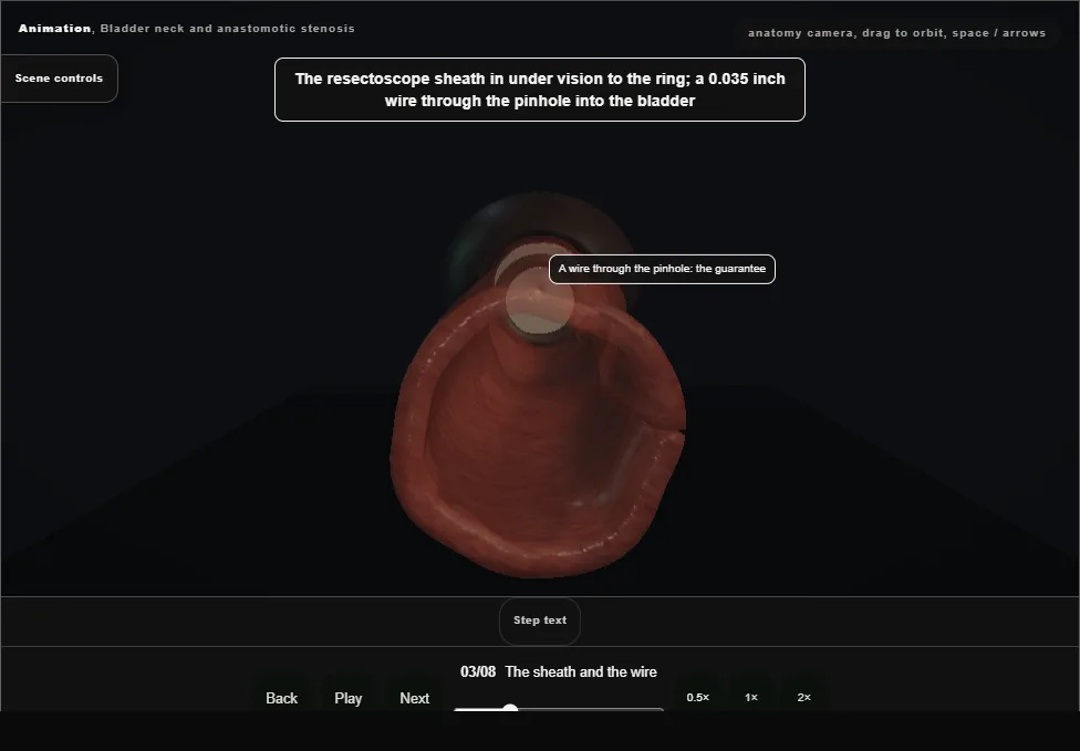 Bladder neck and anastomotic stenosis. Step 3: The sheath and the wire. Captured frame from the interactive animation.