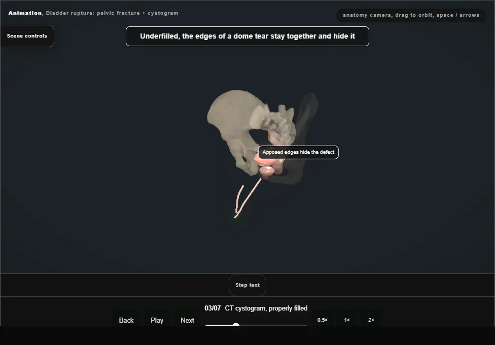 Bladder rupture: pelvic fracture + cystogram. Step 3: CT cystogram, properly filled. Captured frame from the interactive animation.