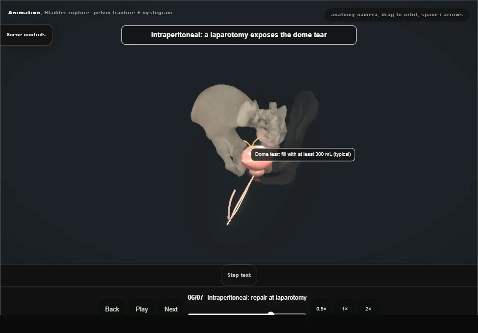 Bladder rupture: pelvic fracture + cystogram. Step 6: Intraperitoneal: repair at laparotomy. Captured frame from the interactive animation.