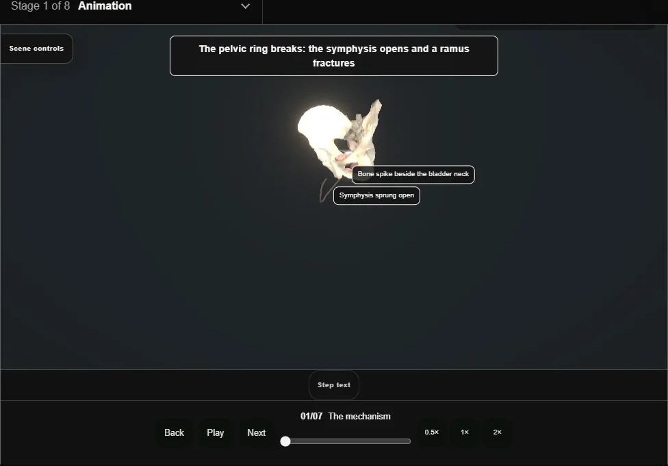 Bladder rupture: pelvic fracture + cystogram. Step 1: The mechanism. Captured frame from the interactive animation.