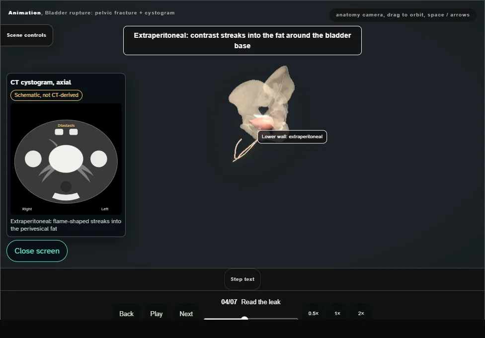 Bladder rupture: pelvic fracture + cystogram. Step 4: Read the leak. Captured frame from the interactive animation.