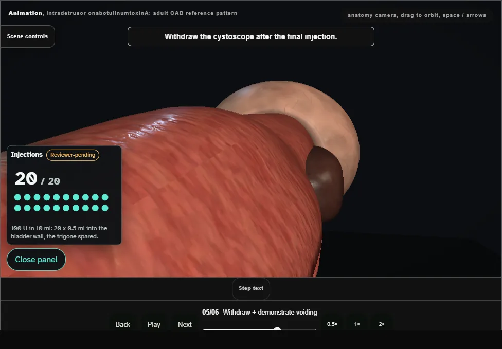 Intradetrusor onabotulinumtoxinA: adult OAB reference pattern. Step 5: Withdraw + demonstrate voiding. Captured frame from the interactive animation.