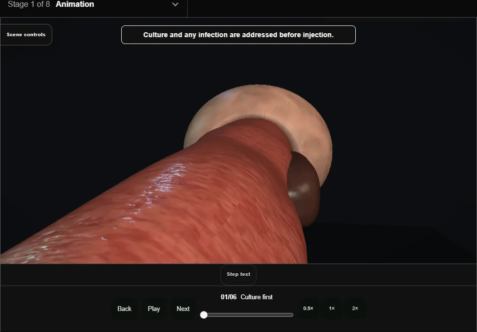 Intradetrusor onabotulinumtoxinA: adult OAB reference pattern. Step 1: Culture first. Captured frame from the interactive animation.