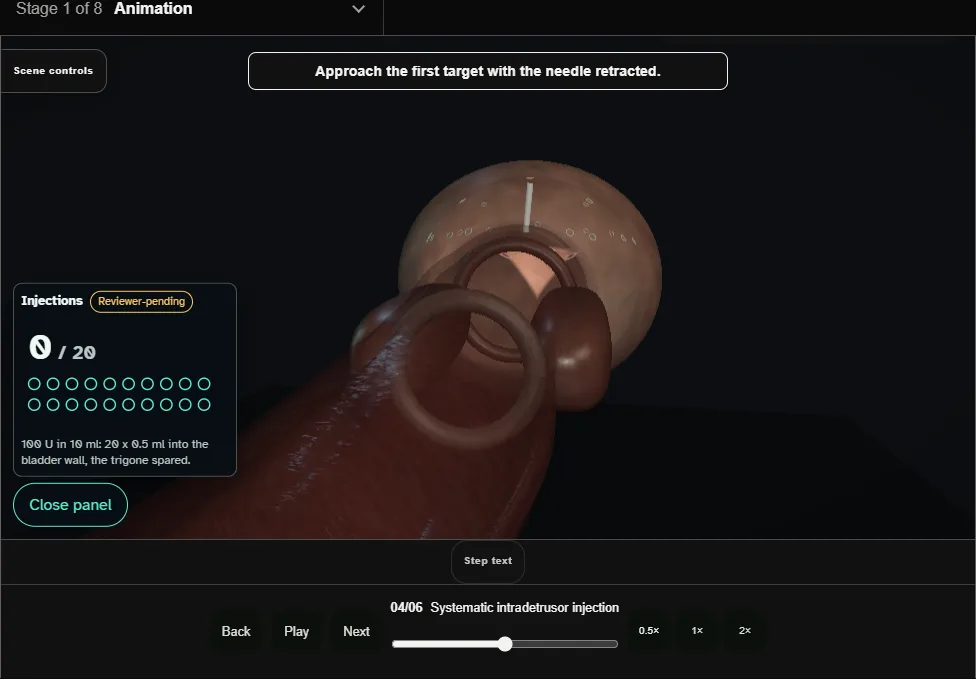 Intradetrusor onabotulinumtoxinA: adult OAB reference pattern. Step 4: Systematic intradetrusor injection. Captured frame from the interactive animation.