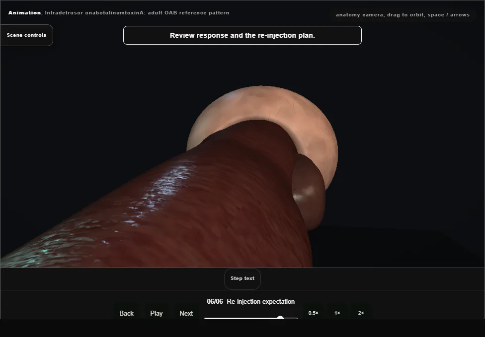 Intradetrusor onabotulinumtoxinA: adult OAB reference pattern. Step 6: Re-injection expectation. Captured frame from the interactive animation.