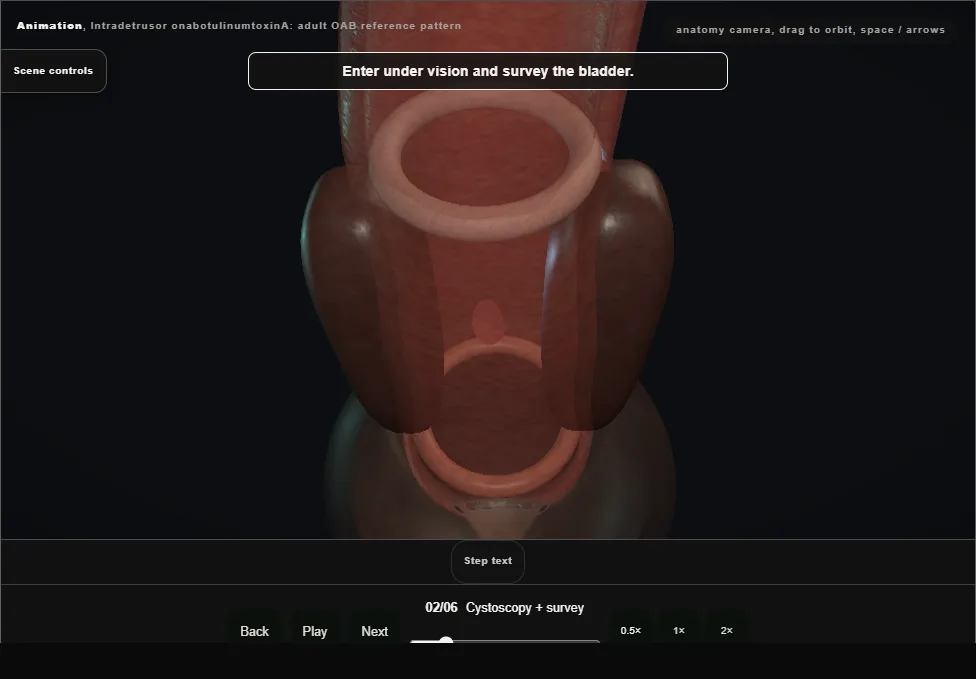 Intradetrusor onabotulinumtoxinA: adult OAB reference pattern. Step 2: Cystoscopy + survey. Captured frame from the interactive animation.
