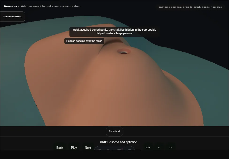 Adult acquired buried penis reconstruction. Step 1: Assess and optimise. Captured frame from the interactive animation.