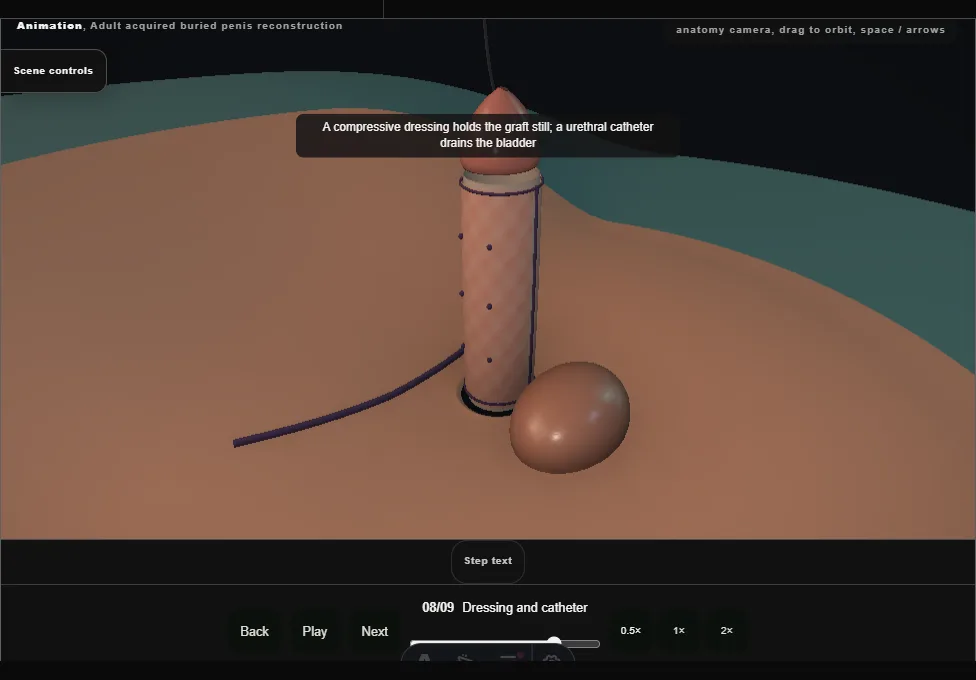 Adult acquired buried penis reconstruction. Step 8: Dressing and catheter. Captured frame from the interactive animation.