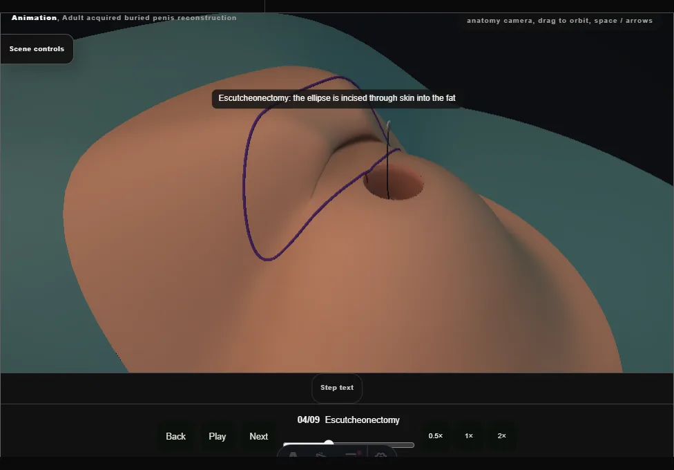 Adult acquired buried penis reconstruction. Step 4: Escutcheonectomy. Captured frame from the interactive animation.