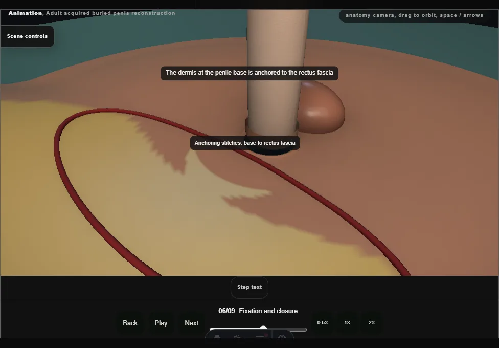 Adult acquired buried penis reconstruction. Step 6: Fixation and closure. Captured frame from the interactive animation.
